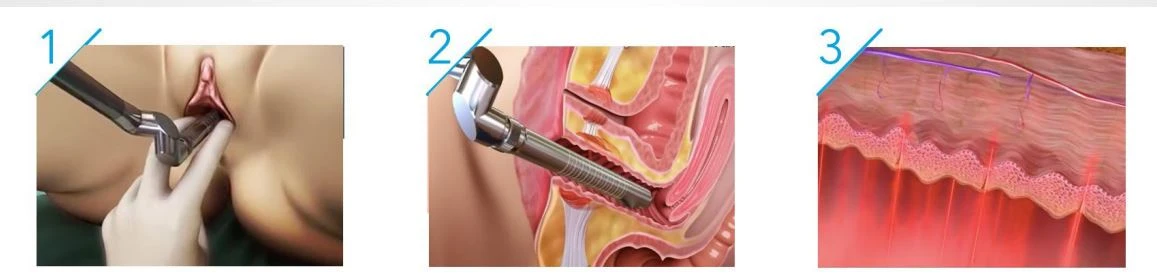 CO2 Vagina Tightening