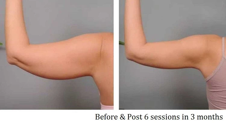 Arm Slim Before After 2
