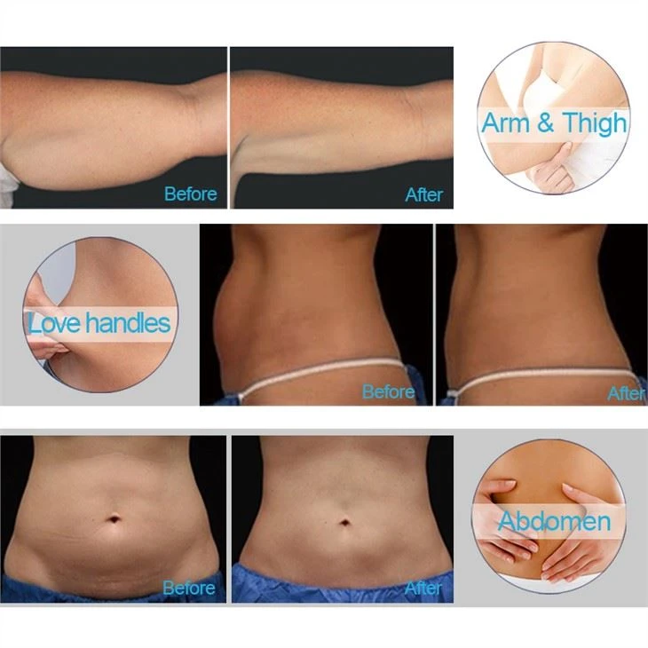 Professional FDA Anti Cellulite Fat Freezing Machine