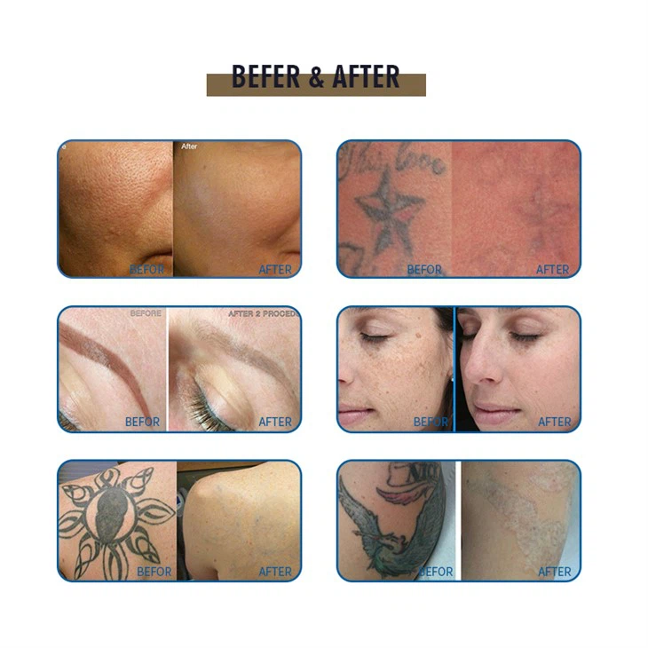 ND YAG Laser Tatto Removal Machine