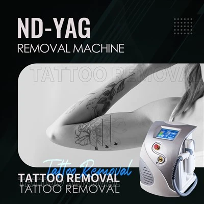ND: YAG LASER 1064NM Húðflúrflutningsvél